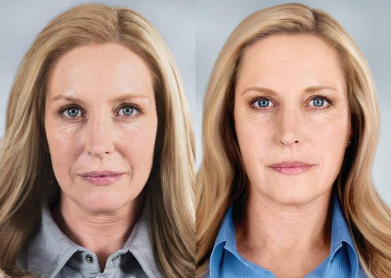 Красивые девушки и Эффект ботокса