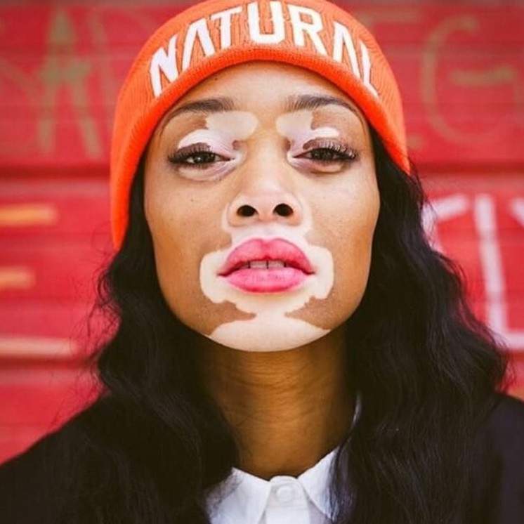 Темная красивая девушка с белоснежными пятнами на фото