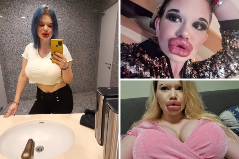 Любительница самых больших в мире губ решила увеличить скулы